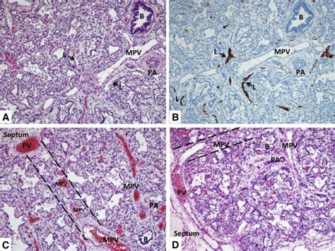 Lung Histology From A Young Infant Who Died Of Acdmpv Hematoxylin And