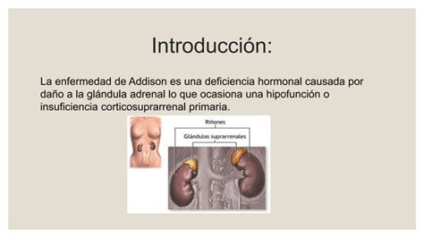 La Alteracion Enfermedad De Addison Medicina PPT