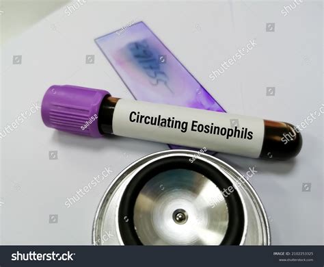 Blood Sample Circulating Eosinophils Test Medical Stock Photo ...