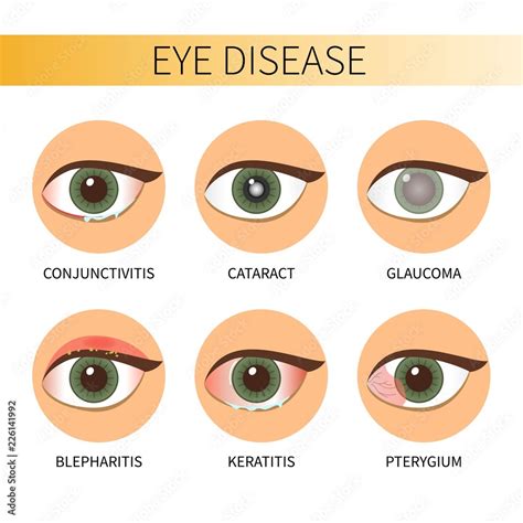 Eye diseases vector illustration. Stock Vector | Adobe Stock