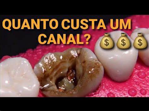 Quanto Custa Um Canal No Dente Direto Ao Ponto Youtube