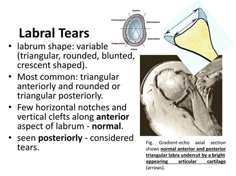 Mri Shoulder Joint With Common Pathologies Ppt