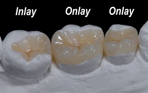 Porcelain Ceramic And Zirconia Crowns Bridges And Inlays Ralev