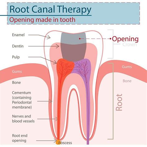 How To Know If Your Tooth Needs Root Canal Symptoms And Treatment