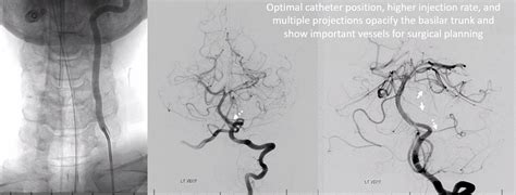 The Art Of Cerebral Angiography Neuroangio Org