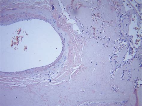 Haematoxylin Eosin Staining Of The Amyloid Deposits In The Specimen