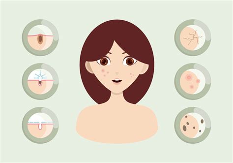 Pimple Illustration 161307 Vector Art at Vecteezy