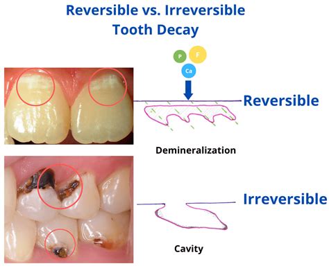 Tooth Decay Process