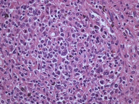 Lymphomas Involving The Spleen Diagnostic Histopathology