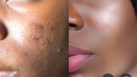 How To Cover Acne Scars Feat Best Concealer For Dark Spots Everyday