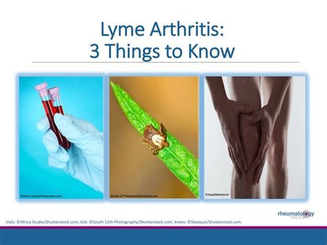 Lyme Arthritis: 3 Things to Know | Rheumatology Network