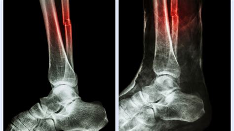 Clasificación De Fracturas De Peroné Tipos Y Tratamientos