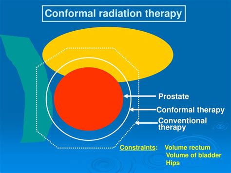 Ppt Prostate Cancer Radiation Therapy Approaches Powerpoint