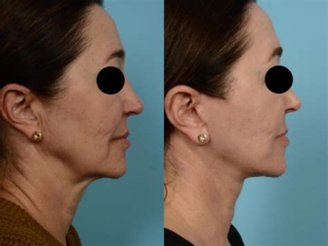 Facelift Minilift By Dr Sinno Before And After Pictures Case