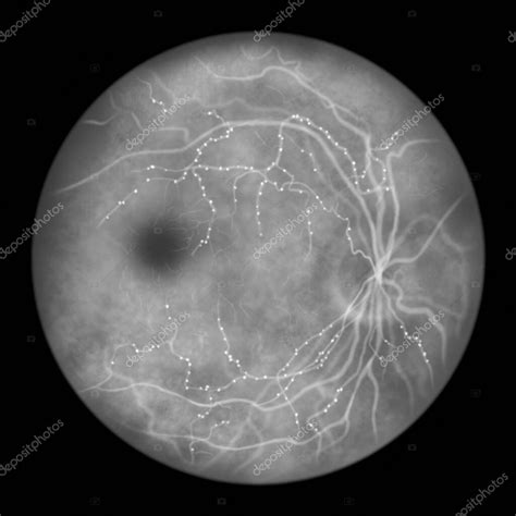 Retinopatía Diabética Forma Clínica R1 Antecedentes Con Microaneurismas Vista Oftalmoscópica