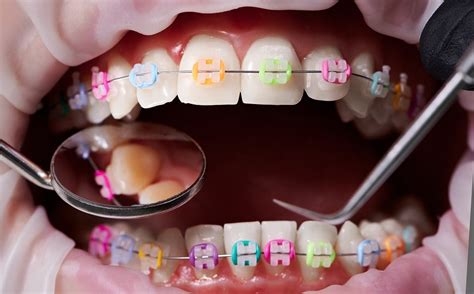 5 Signs Of Tooth Decay With Braces Smile Style Ny