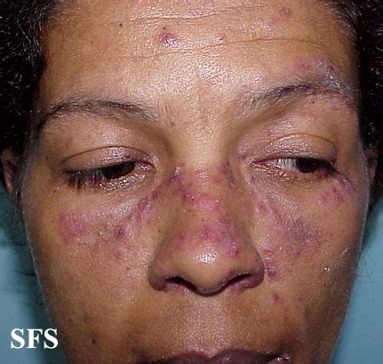 Lupus Erythematosus Subacute Cutaneous Lupus Erythematosus Nc Commons