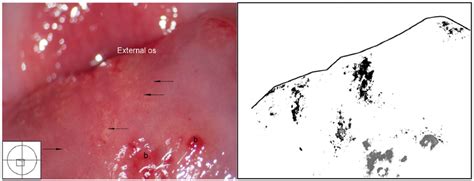 Grainy Sandy Patches Trichomoniasis Petechiae And Mucosal Bleeding