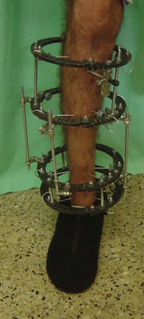 External Fixation Device Hoffmann 3 External Fixation System | Stryker