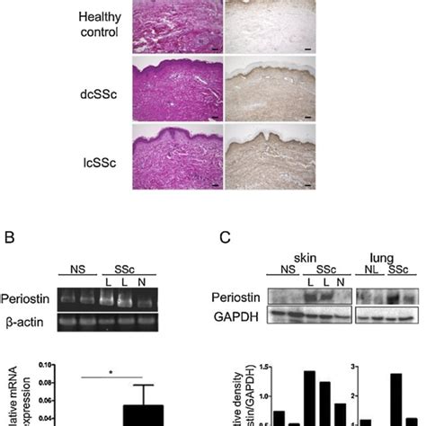 Periostin Expressions In The Skin And Skin And Lung Fibroblasts Of Ssc