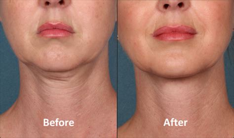 Nefertiti Neck Lift Nefertiti Neck Lift