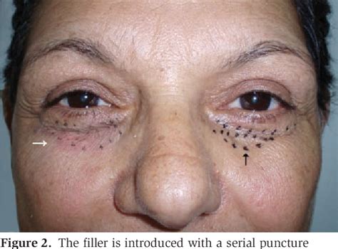 Figure 2 From Treatment Of The Tear Trough Deformity With Hyaluronic