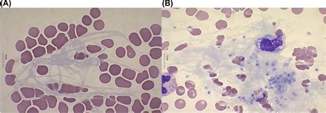 Fibrin Strands A Fibrin Strands In Peripheral Blood Smear B