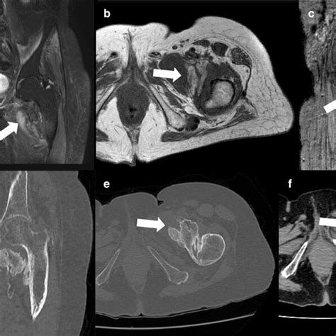 Pelvis Mr A Sagittal And B Axial T2 Fat Saturated Imaging