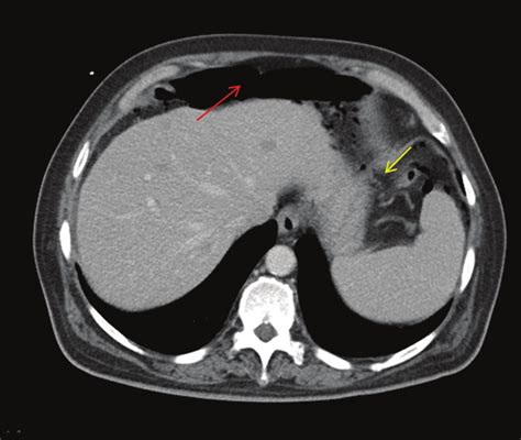 CT Scan Of The Abdomen Showing Free Intraabdominal Air Red Arrow Due