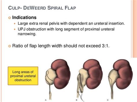 Lap Pyeloplasty