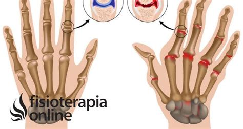 Artritis Reumatoide Qu Es Fases Y Tratamiento M Dico Y De