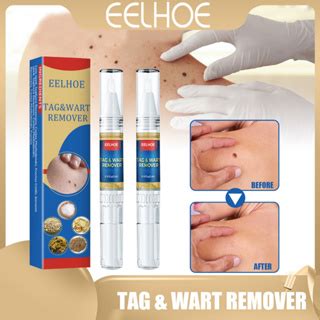 Eelhoe Warts Mole Remover Skin Tag Ointment Warts Remover Mole Removal