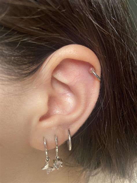 Irritation Or Keloid On Helix Rpiercing