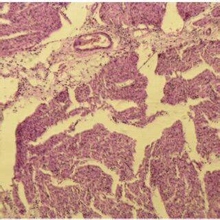 Histopathological Analysis Of Autopsy Of Brain Tissue Of Patient K