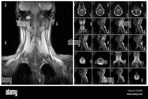 Resonancia magnética nuclear de cuello Resobert Medicina Radiología