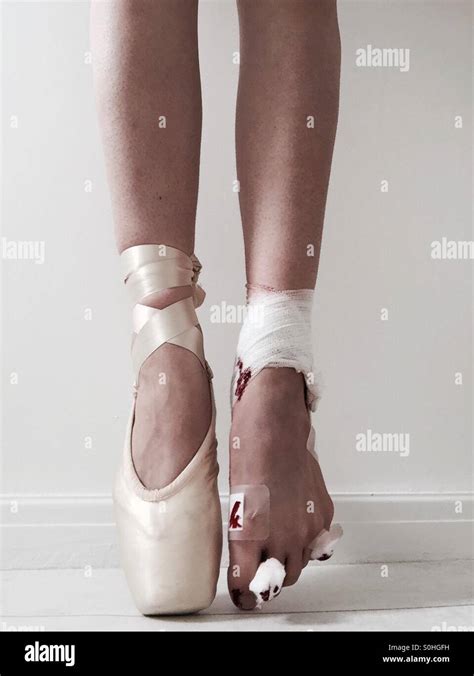 Ballerina Feet Conditions That Cause Ballerina Feet Damage Atelier