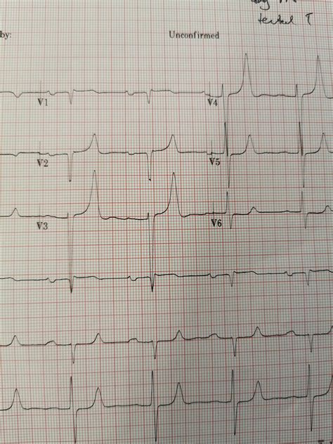 ECG of a man with a potassium of 9.1 : medizzy