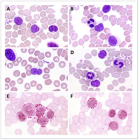 Sezary Cells