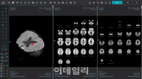 제이엘케이 뇌경색 진단 솔루션 의료현장 도입 목전 네이트 뉴스