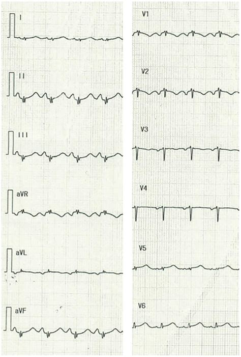 Electrocardiogram Electrocardiography Revealed Sinus Tachycardia Low