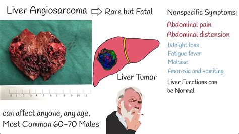 Liver Angiosarcoma Symptoms And Treatment Liver Angiosarcoma Prognosis Life Expectancy Youtube