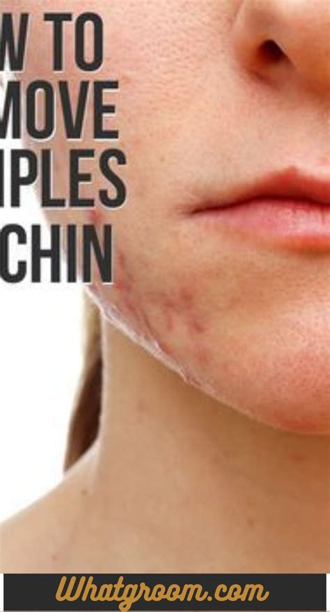 Chin Acne Pimples Causes Treatment And Skin Care Tips Artofit