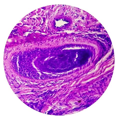 La Vista Microscópica Del Carcinoma Basocelular Es Un Tipo De Cáncer De