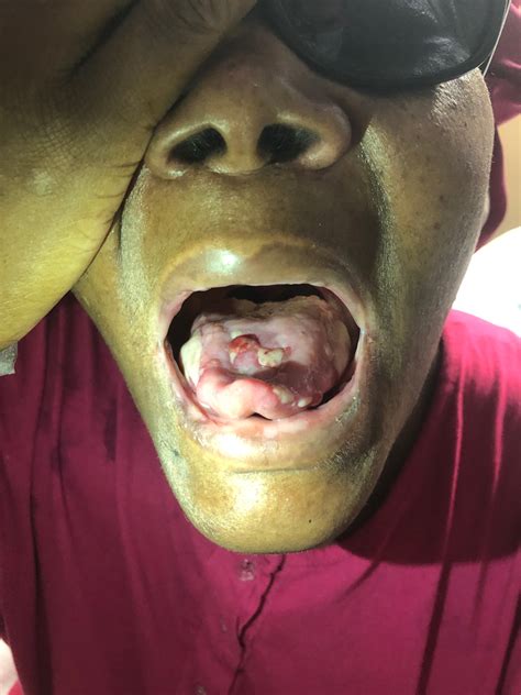 Idiopathic Linear Iga Bullous Dermatosis With Mucosal Involvement