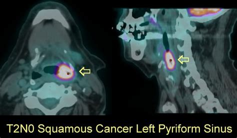 pyriform sinus cancer