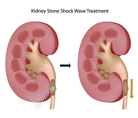 Lithotripsy Treatment For Urinary Stones Fv Hospital