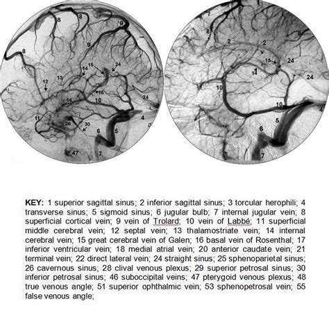 Dr Balaji Anvekar Frcr Normal Intracranial Venous System