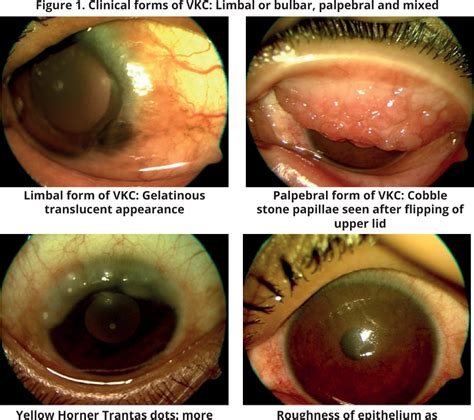 Figure From Allergic Conjunctivitis Semantic Scholar