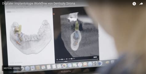 Digitaler Implantologie Workflow Von Dentsply Sirona Frag Pip