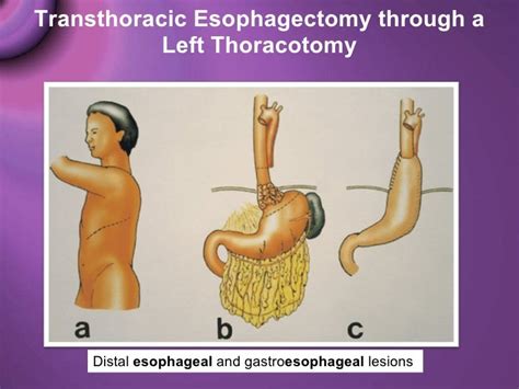 Esophaegeal Resection And Reconstruction